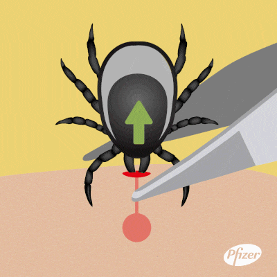 Removing a tick with tweezers